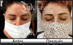 Ink Laser Eliminar Estrías en Alicante (Alacant)