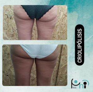 Centro de Estética - Phi Belleza Natural Tratamiento de Acné en Sevilla