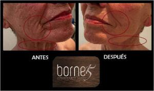 Clínica de Medicina Estética Borne 15 Clínica Reducción Corporal en Palma