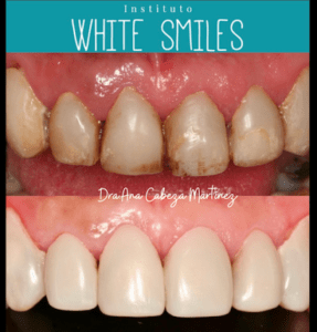 Instituto White Smiles Colocación de Brackets en Majadahonda