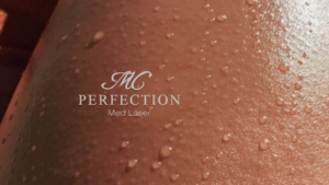MC Perfection Med Láser Microdermoabrasión en Vigo