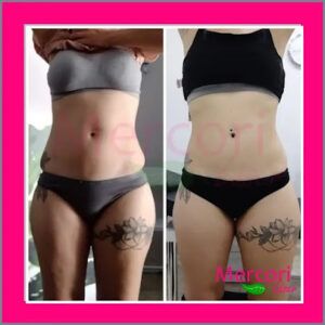 Mercori Laser Microdermoabrasión en Palma del Río